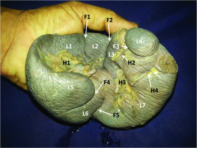 【佳学基因检测】分叶脾/多叶脾基因检测 Multilobulated spleen