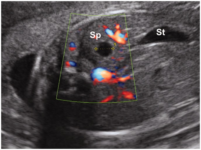 【佳学基因检测】脾囊肿基因检测 Splenic cyst