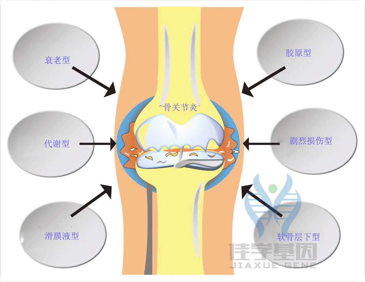 【佳学基因检测】骨关节炎基于基因检测的分子诊断分型